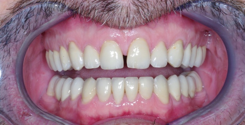 Denti Consumati