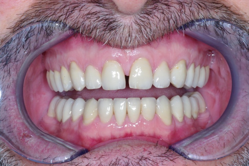 Denti Consumati