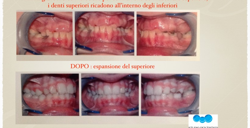 Ortodonzia Intercettiva