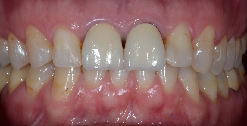 Bordo nero intorno al dente incapsulato