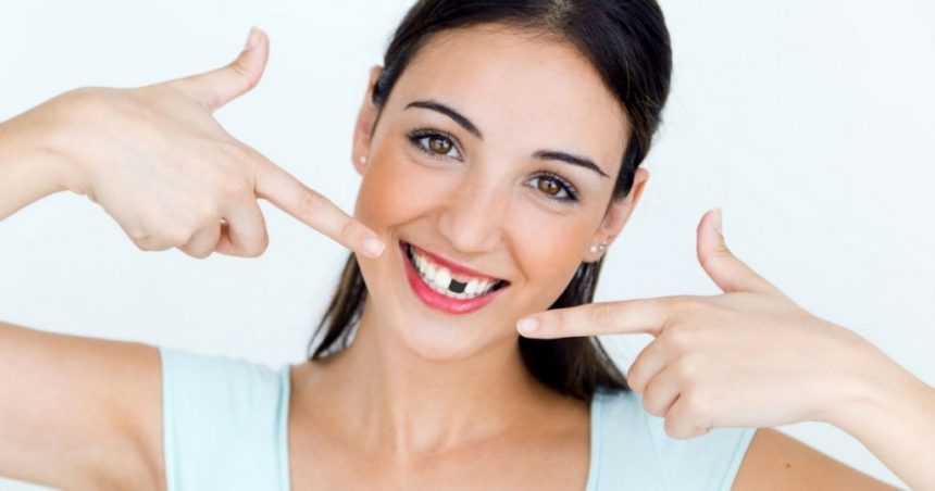 Denti su Impianti: la Qualità è data dai dettagli Denti su Impianti: la Qualità è data dai dettagli