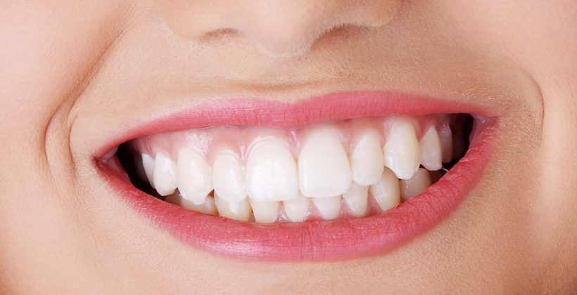 impianti dentali il costo
