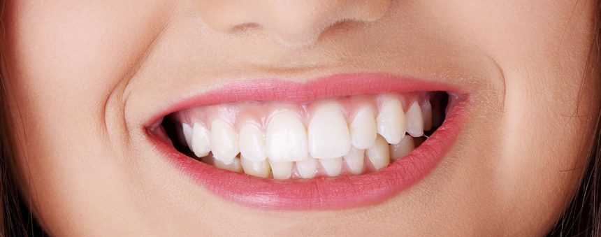 impianti dentali il costo impianti dentali il costo