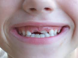 Denti da latte incisivi che tardano a cambiare