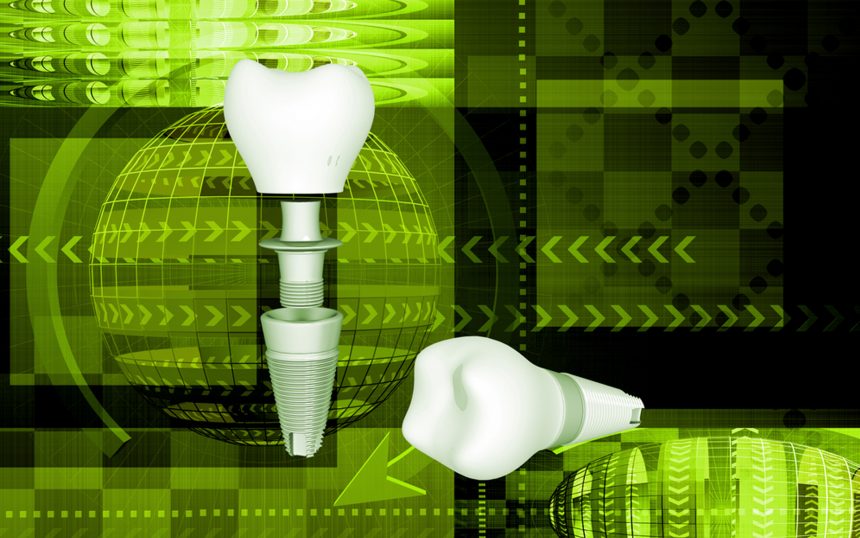 Implantologia: bene e velocemente è decisamente meglio! Com’è possibile? Implantologia: bene e velocemente è decisamente meglio! Com’è possibile?