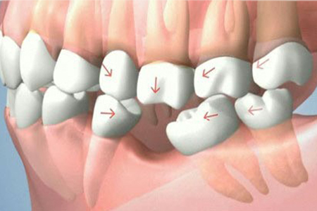Le Conseguenze della perdita di un Dente