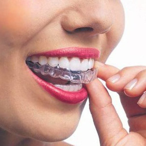 Come Pulire il Bite e l’Apparecchio Ortodontico Invisibile