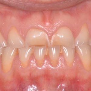 Usura dentale , un tema molto attuale in odontoiatria