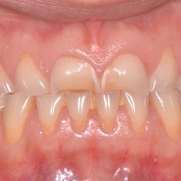 Usura dentale , un tema molto attuale in odontoiatria