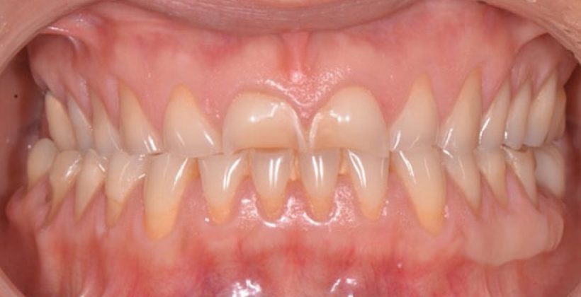 Usura dentale , un tema molto attuale in odontoiatria